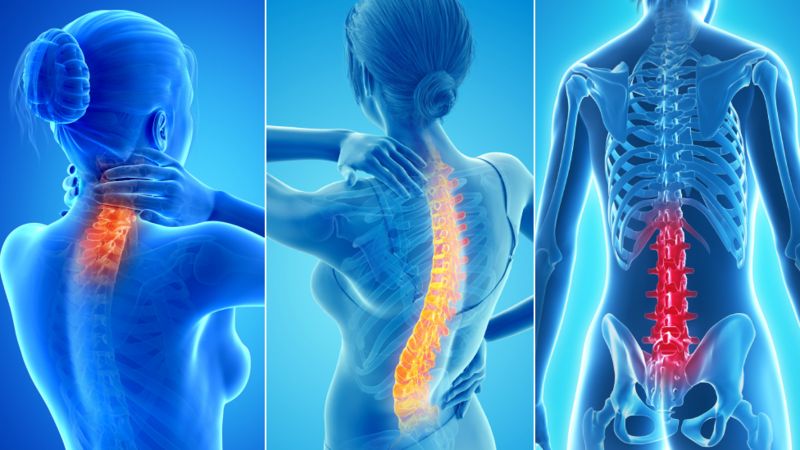 El dolor de espalda se identifica según su localización: cervicalgia, cuando afecta a la zona cervical (izq.); la dorsalgia, si duele la la región dorsal; (enctro) y la lumbalgia, en la parte más baja (der.).

